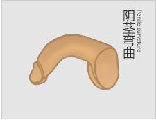男性必看：导致阳具变弯的原因
