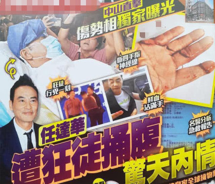 任达华右手伤口曝光 经纪人透露：将于明天出院